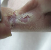 Load image into Gallery viewer, Footlogix PEELING SKIN FORMULA