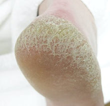 Load image into Gallery viewer, Footlogix ROUGH SKIN FORMULA