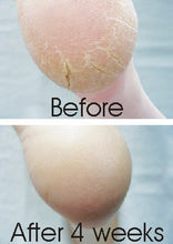 Load image into Gallery viewer, Footlogix CRACKED HEEL FORMULA